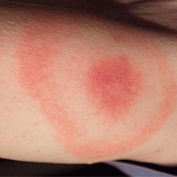 Ziekte-van-lyme - Genezing ziekte van Lyme